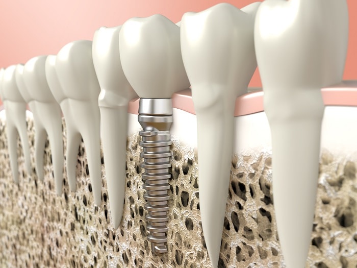 Dental Implant