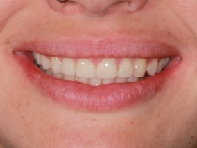 choice-dental-veneers-femail-before