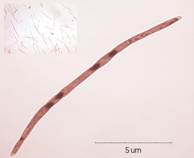 Oral bacteria linked to the development and progression of oesophageal cancer