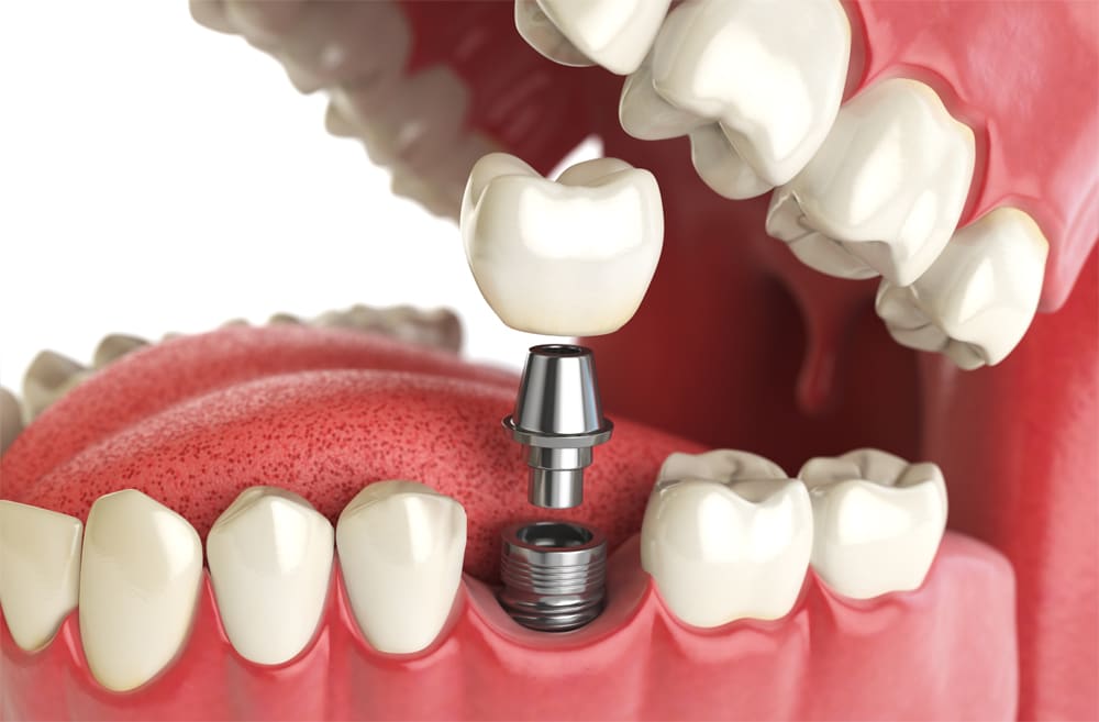 Dental Implants - the permanent solution to missing teeth - Choice Dental