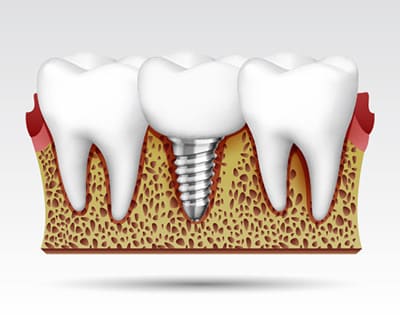choice-dental-implant-browns-plains-dental
