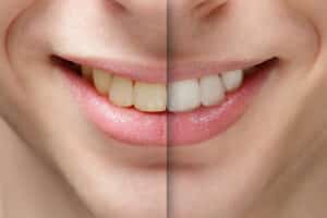 Browns-plain-dental-in-chair-tooth-whitening-Brisbane