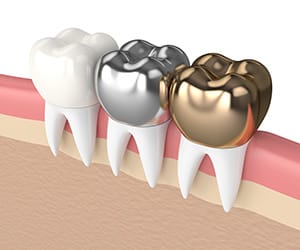 Brwons-plains-Choice-Dental-crows-materials