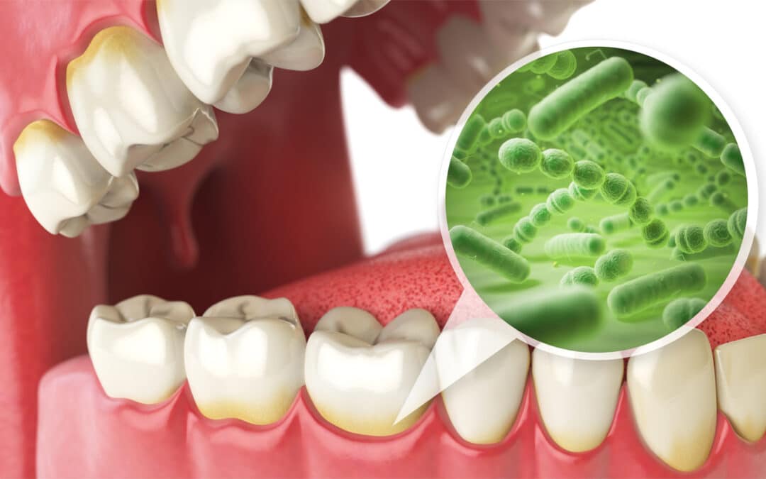 How Oral Bacteria Can Affect the Rest of Your Body