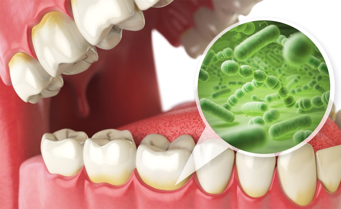 How oral bacteria can affect the rest of your body - Choice Dental