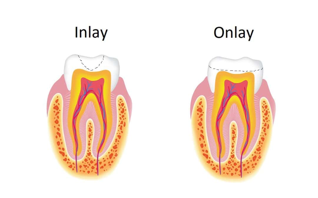 Inlays & onlays – the conservative tooth restoration