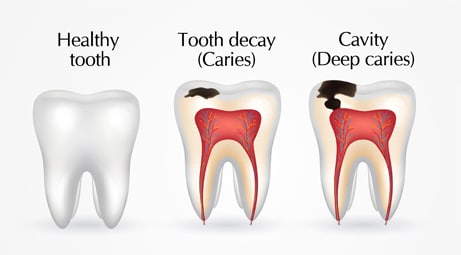 What's the Difference: Tooth Decay vs. Cavities?