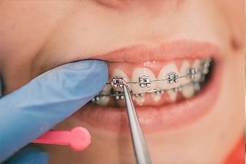 choice-dental-braces-Browns-Plains