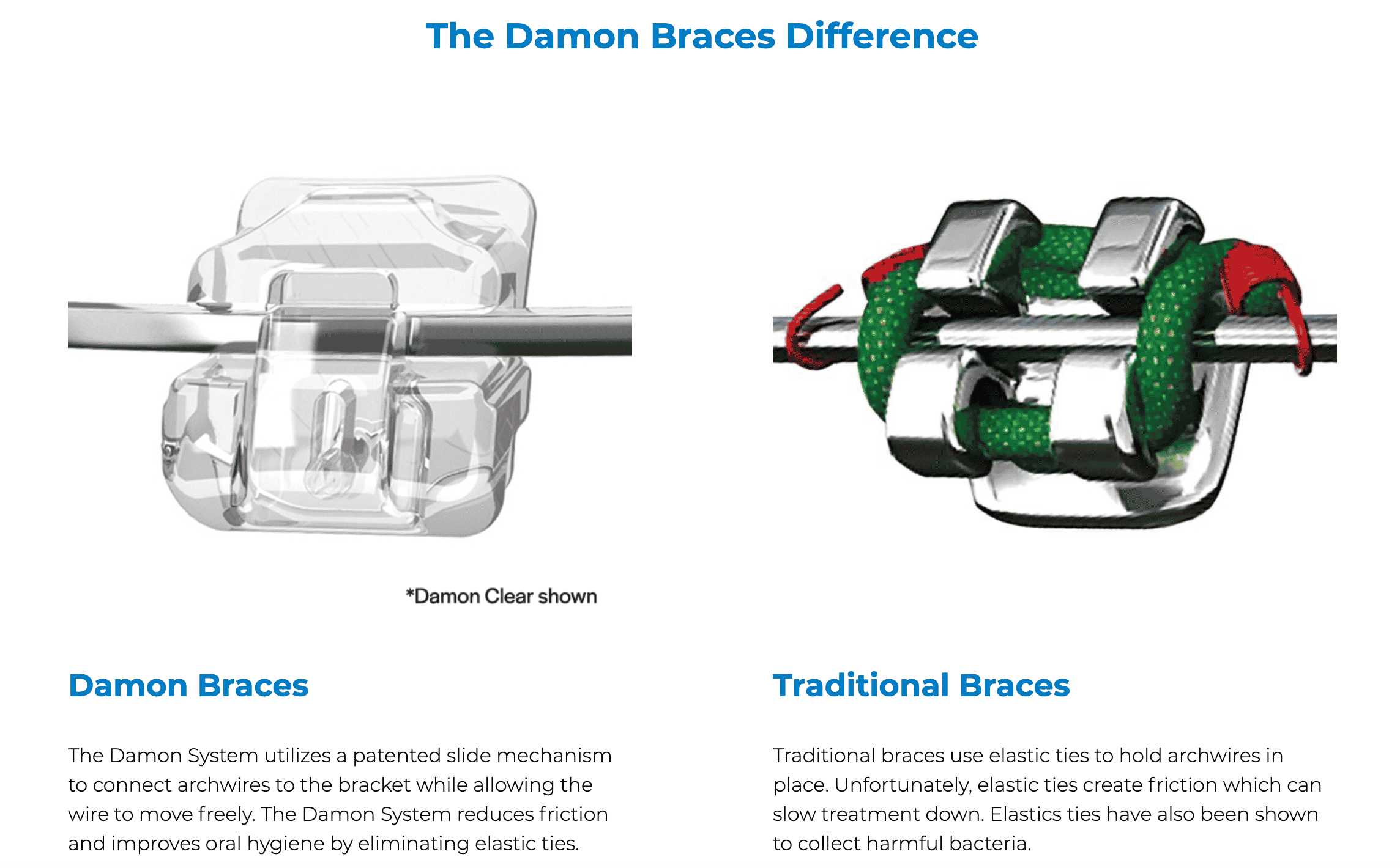 damon braces difference