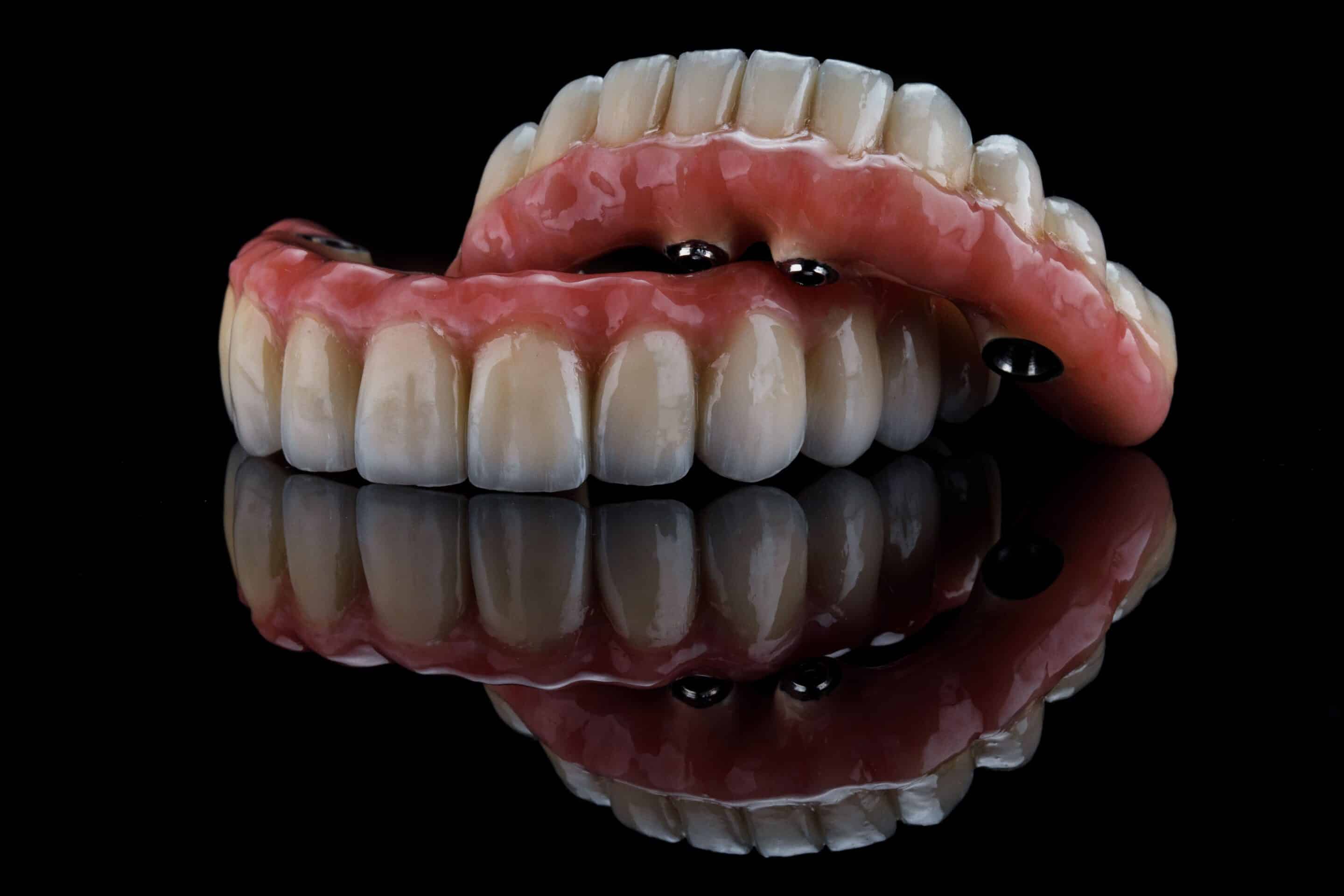 overdentures