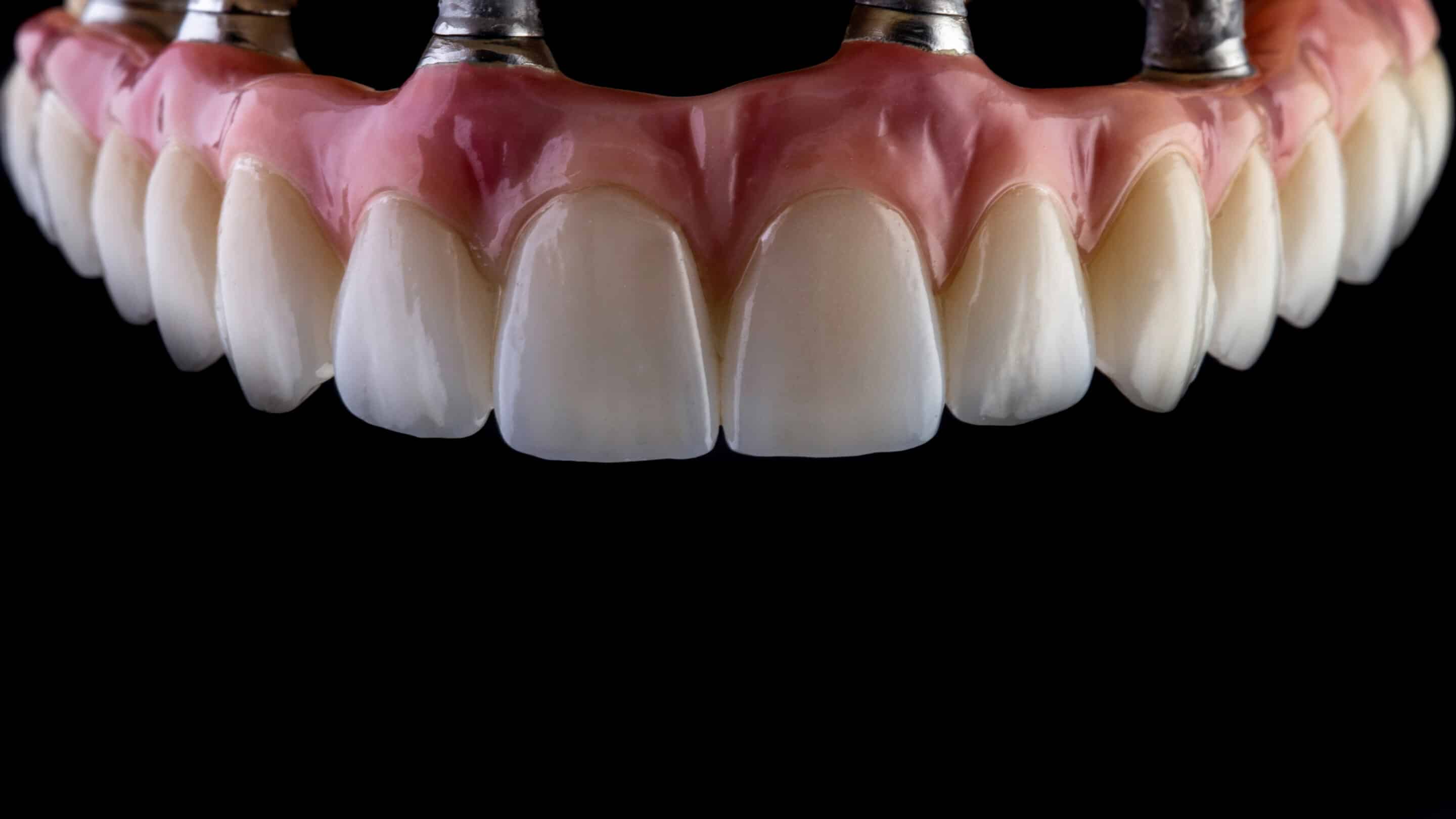 implant overdentures