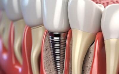 5 Reasons Not to Get Dental Implants