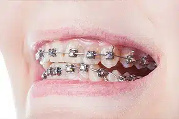 braces-damon.jpg