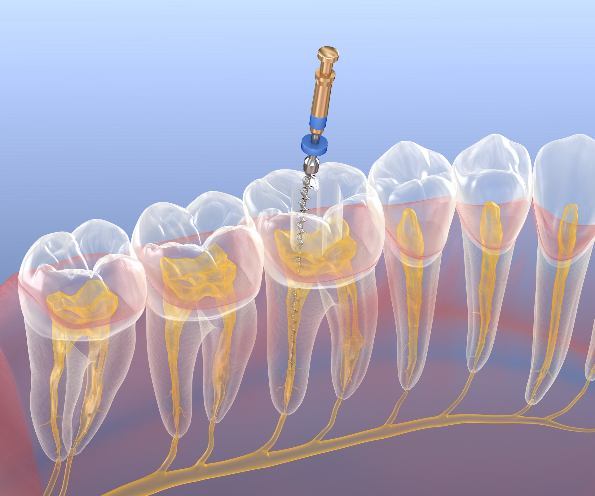 Endodontic root canal treatment process