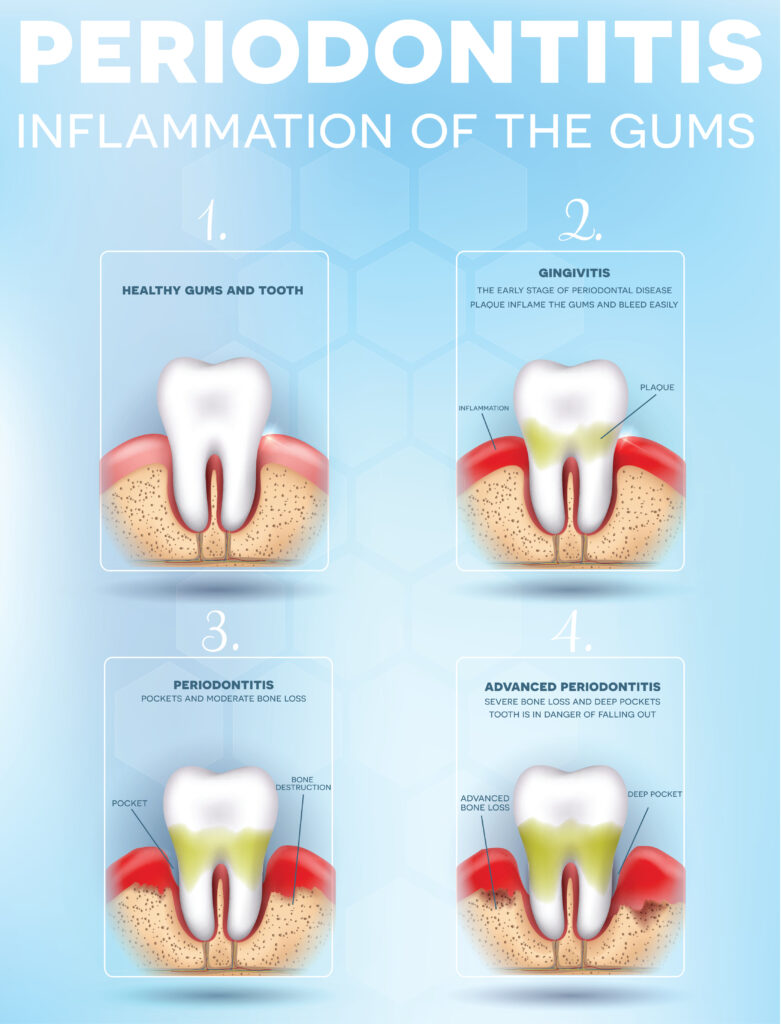 Periodontitis, inflammation of the gums stages, detailed illustration. Healthy tooth, Gingivitis and at the end advanced Periodontitis