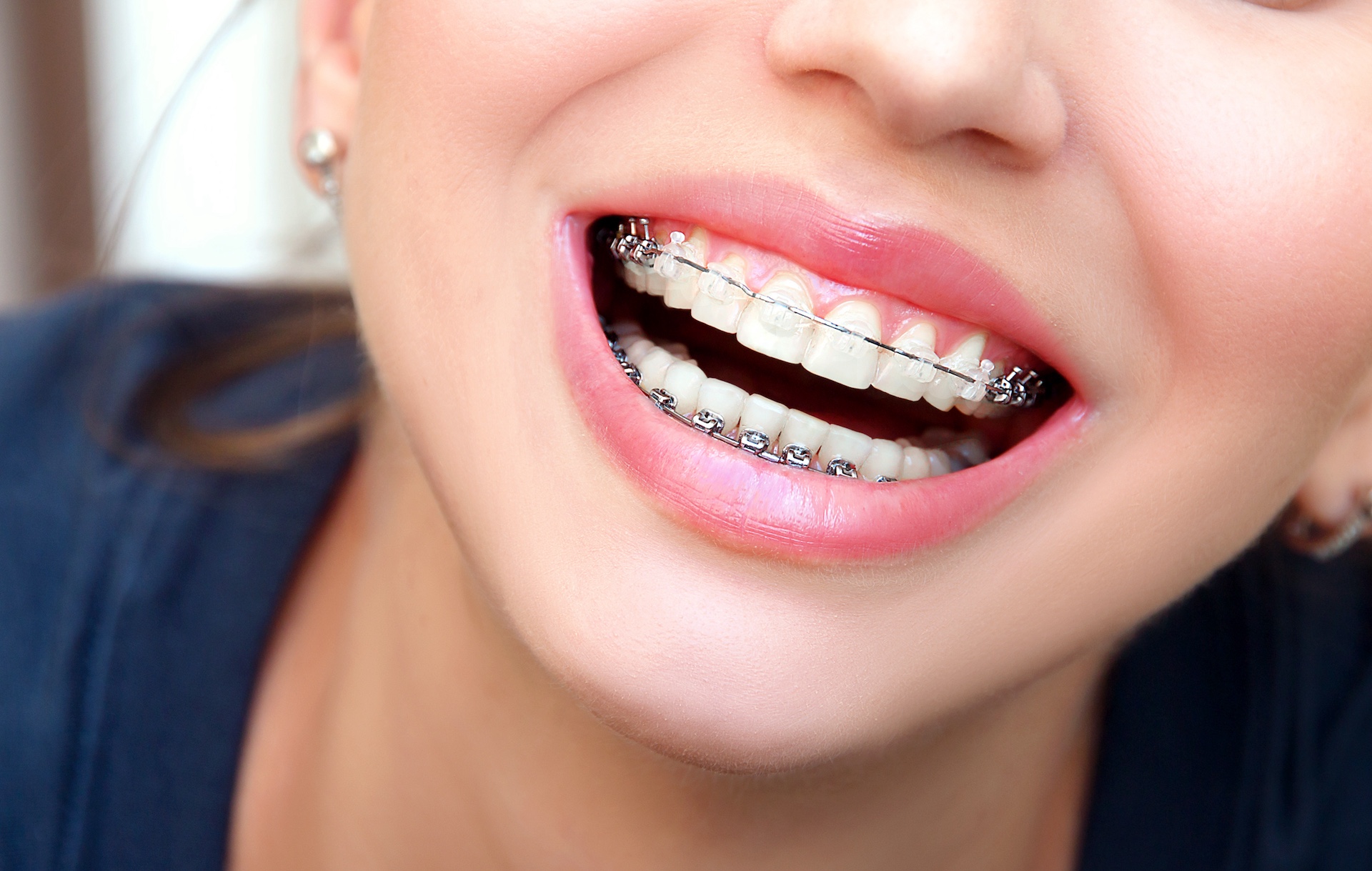 damon-braces damon-braces