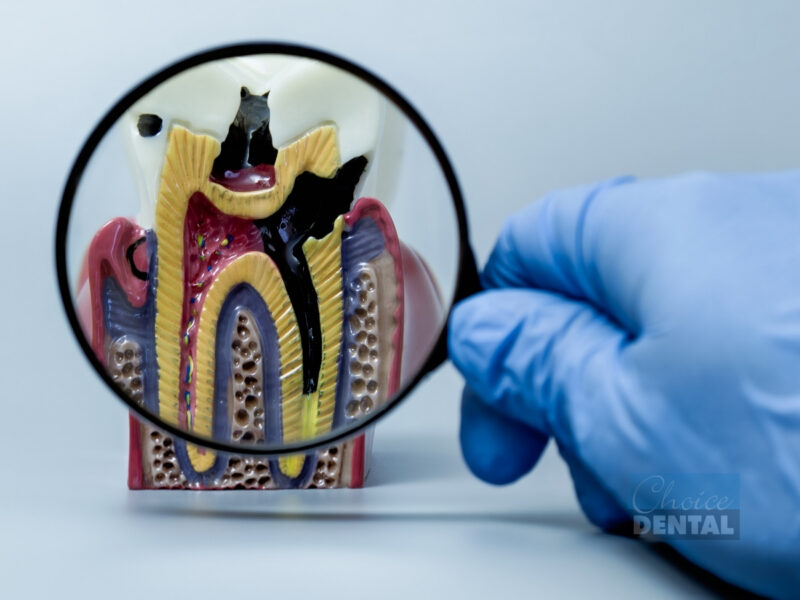 Guide to Tooth Erosion