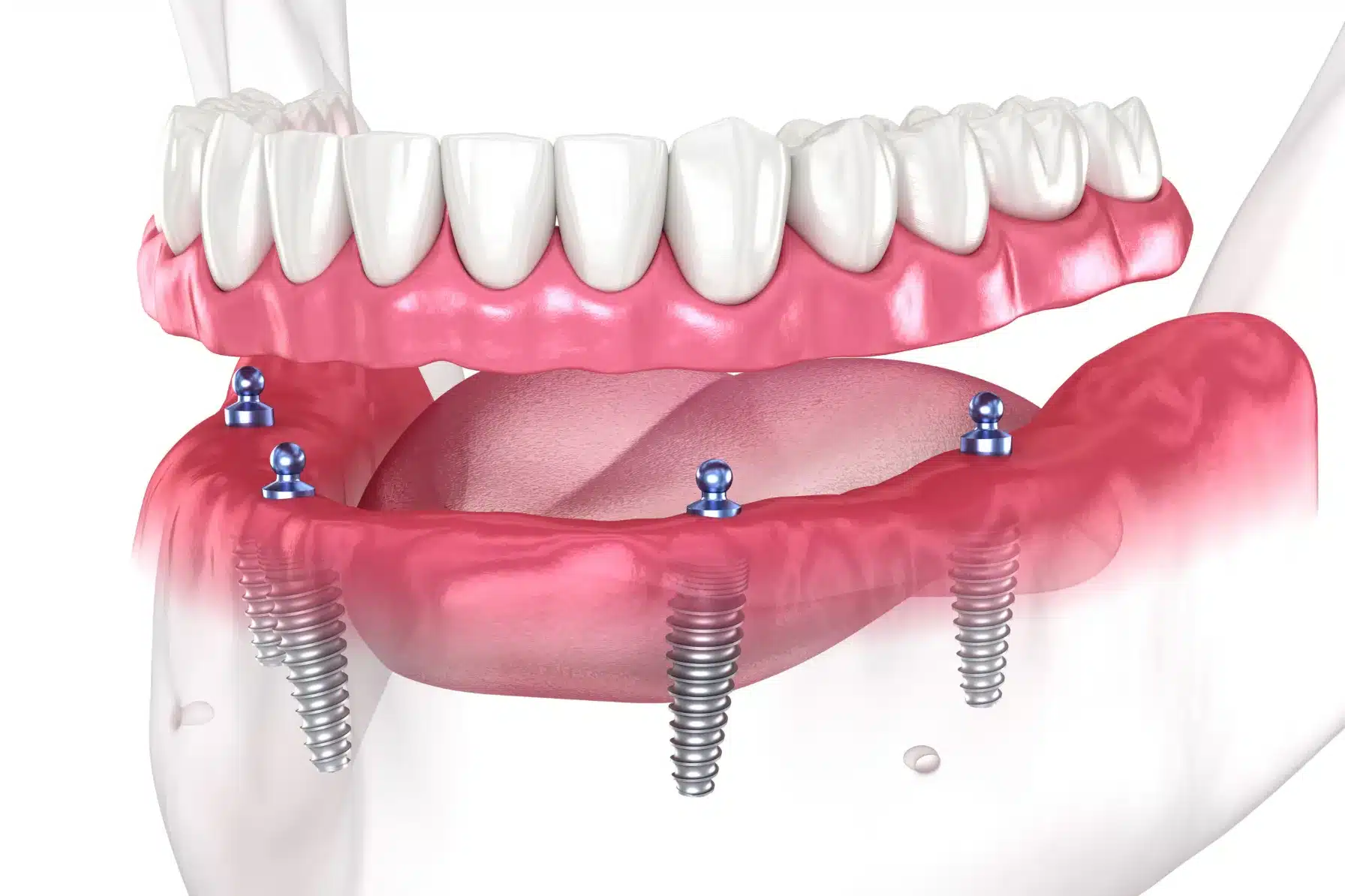 Full Mouth Dental Implants